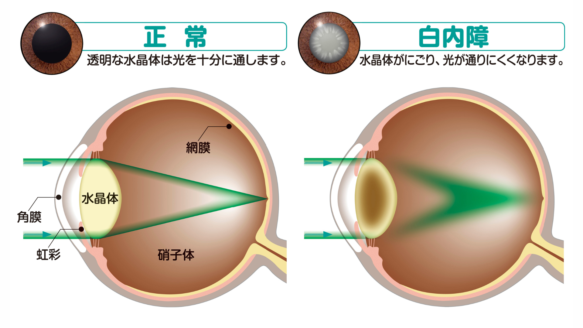 白内障