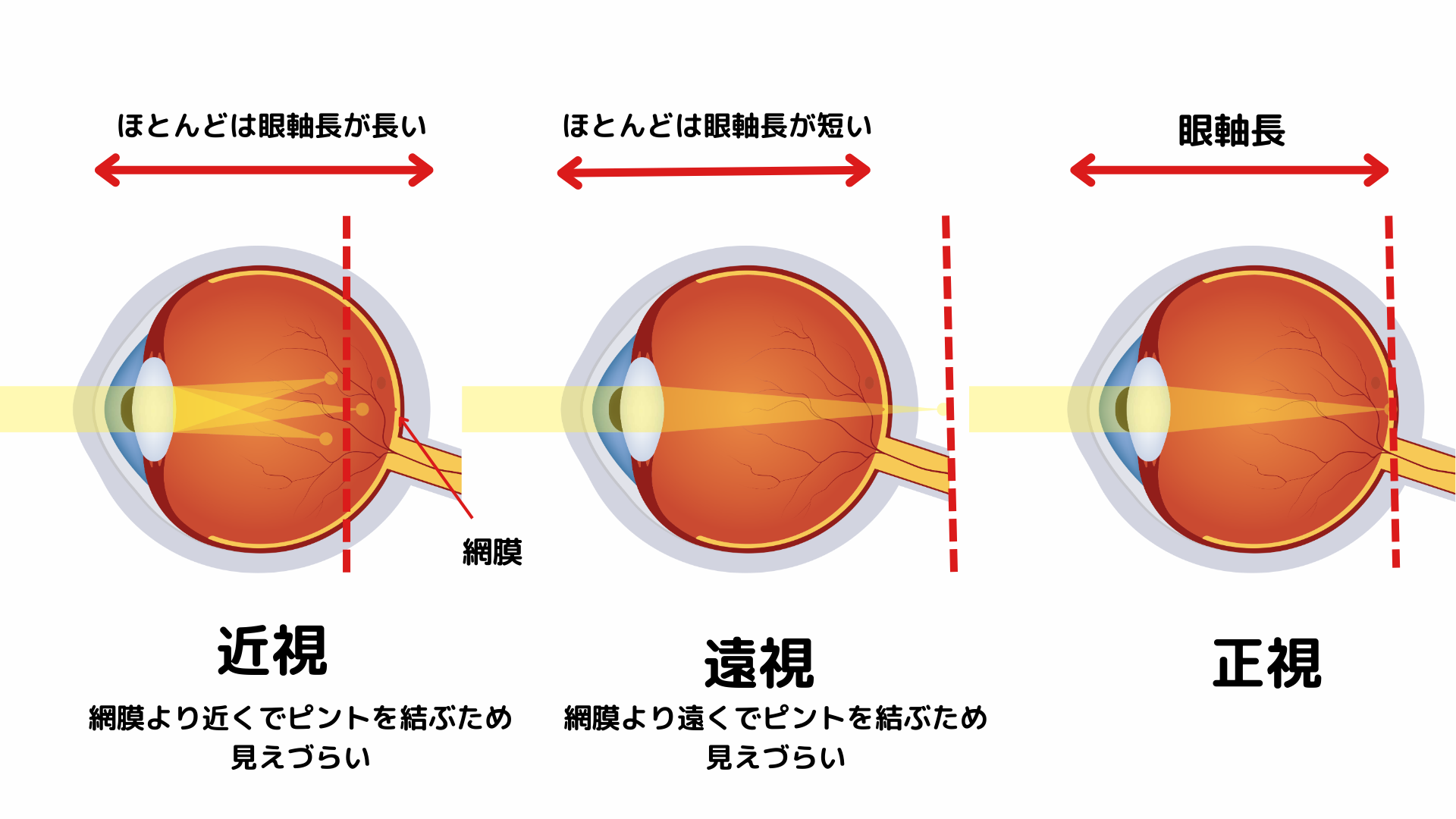 子供の近視にお悩みの方へ