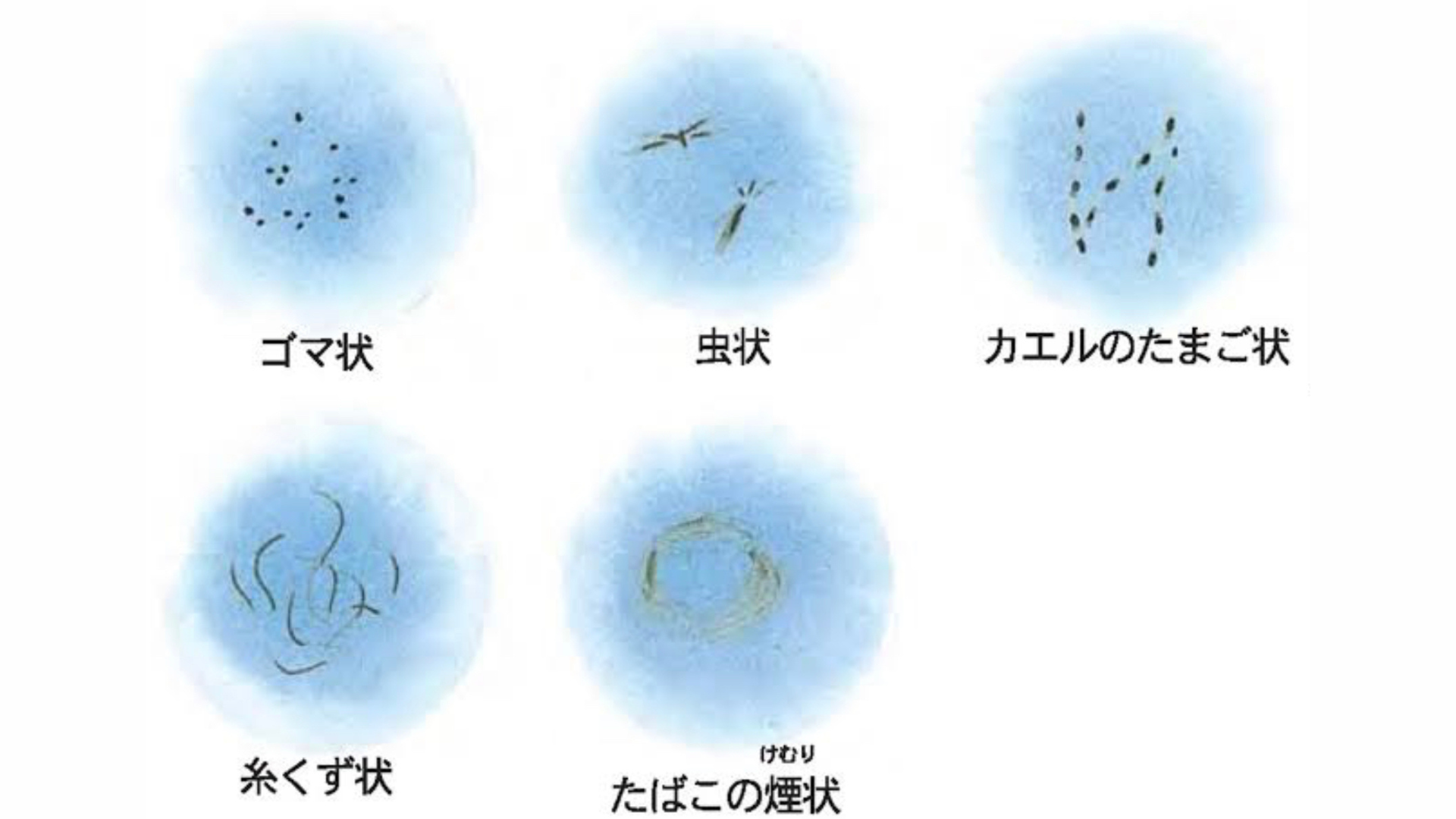 飛蚊症