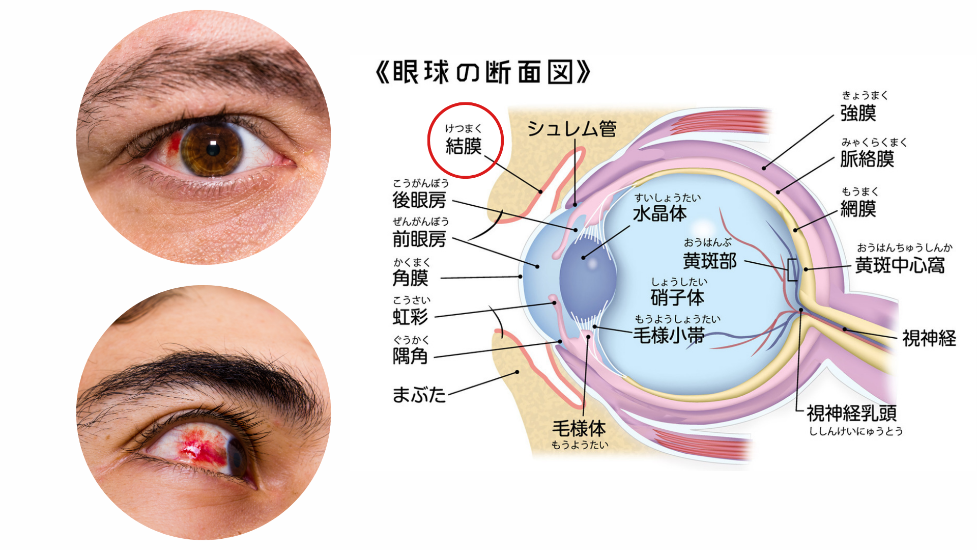 VDT症候群（IT眼症・テクノストレス眼症）